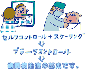 歯周病の治療は プラークコントロールから